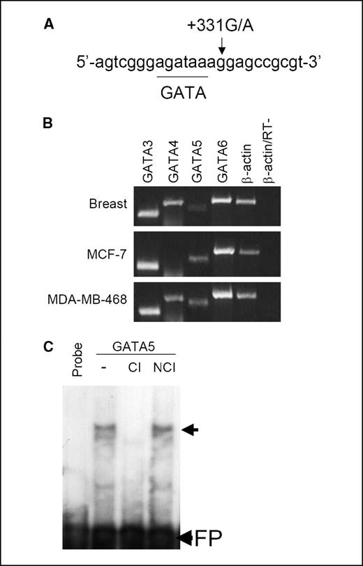 Figure 1. A, location of a predicted GATA-protein binding site adjacent to the +331G/A polymorphism in the progesterone receptor gene. B, GATA5 is more strongly expressed in two breast cancer cell lines. GATA and β-actin transcripts were amplified by PCR following cDNA synthesis from normal breast (top), cultured MCF-7 (middle), and MDA-MB-468 (bottom) cell total RNA. C, GATA5 binds the predicted GATA recognition site adjacent to the +331G/A polymorphism. The [32P]-labeled oligonucleotide, shown in (A), was retained by GATA5 (arrow) in the absence of an inhibitor (−) and in the presence of a cold noncompetitive inhibitor (NCI). Inclusion of an unlabeled competitive inhibitor (CI) oligonucleotide, which contains a known GATA binding site, blocked complex formation. The free probe (FP) is shown at the bottom.