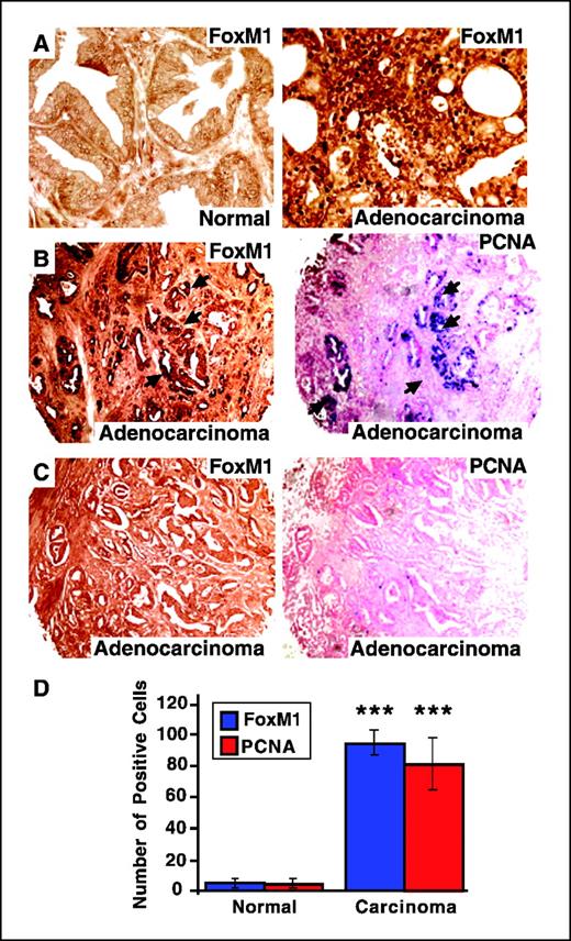 Figure 1. FoxM1 is expressed in highly proliferative human prostate adenocarcinomas. Prostate cancer tissue arrays (US Biomax) were immunostained with FoxM1 antibody as described in Materials and Methods. A, increased nuclear levels of FoxM1 protein in human prostate adenocarcinomas (right) compared with corresponding adjacent normal prostate tissue (left). B, FoxM1 and PCNA are coexpressed in human prostate adenocarcinomas. Adjacent paraffin sections of the prostate cancer tissue array were stained with antibody specific to either FoxM1 (left) or PCNA (right) proteins. Prostate cancer tumor sections immunostained for PCNA expression were counterstained with nuclear fast red (PCNA staining regions indicated by arrows). C, FoxM1-negative tumor (left) displays diminished PCNA levels (right). D, correlation between PCNA and FoxM1 staining in human prostate carcinomas. We counted the number of FoxM1 and PCNA-positive nuclei in five fields of proliferating human prostate adenocarcinomas or normal prostate tissue. Columns, mean number of nuclei staining positive for either FoxM1 or PCNA in proliferating human adenocarcinomas versus normal prostate tissue; bars, SD. ***, P < 0.001. Magnification: ×200 (A), ×50 (B and C).