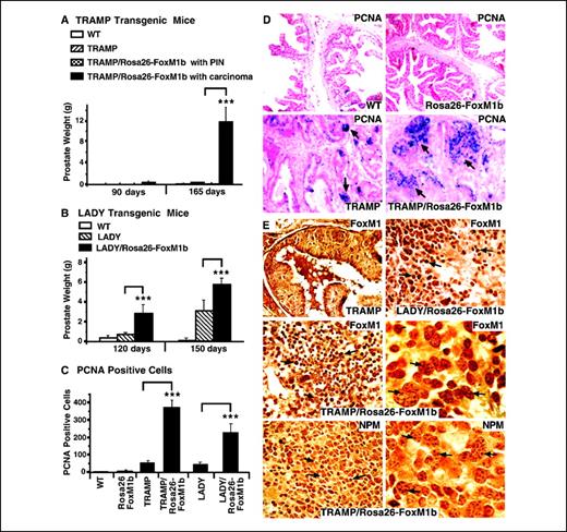Figure 2. TRAMP/Rosa26-FoxM1b and LADY/Rosa26-FoxM1b double TG mice exhibit accelerated growth and development of prostate carcinomas. We sacrificed TRAMP and LADY single TG or TRAMP/Rosa26-FoxM1b and LADY/Rosa26-FoxM1b double TG mice at the indicated time points. Prostate glands were collected and weighed from wild-type (WT; n = 4), Rosa26-FoxM1b (n = 7), TRAMP (n = 7) and LADY (n = 7) single TG mice, and TRAMP/Rosa26-FoxM1b (n = 12) and LADY/Rosa26-FoxM1b (n = 10) double TG mice. Prostate tissue sections were immunochemically stained with antibody specific to either the PCNA or the FoxM1 protein. A, weights of prostate glands containing carcinomas from TRAMP/Rosa26-FoxM1b double TG mice compared with those of TRAMP TG mice. Columns, mean weight of mouse prostate gland; bars, SE. Prostate weight is significantly increased in the subset of TRAMP/Rosa26-FoxM1b double TG mice that developed prostate carcinomas compared with double or single TRAMP TG mice that developed PIN. B, statistically significant increase in weight of prostate glands from LADY/Rosa26-FoxM1b double TG mice compared with those of LADY single TG mice. Columns, mean weight of mouse prostate glands; bars, SE. C, elevated number of PCNA-positive cells in TRAMP/Rosa26-FoxM1b and LADY/Rosa26-FoxM1b double TG mice. Prostate tumor cells undergoing proliferation were detected with antibody specific to PCNA, and prostate tumor sections were then counterstained with nuclear fast red (D). We counted the number of PCNA-positive cells in five random microscope fields from different mouse prostates. Columns, mean number of PCNA-positive cells; bars, SD. Statistically significant increases with Ps calculated by Student's t test (A-C): *, P < 0.05; **, P ≤ 0.01; ***, P ≤ 0.002. E, nucleolar localization of FoxM1 protein in mouse prostate tumors from TRAMP/Rosa26-FoxM1b double TG mice. Prostate tissue sections from TRAMP, TRAMP/Rosa26-FoxM1b, and LADY/Rosa26-FoxM1b double TG mice were immunostained with antibody specific to either FoxM1 protein or the nucleolar Nucleophosmin (NPM) protein (49, 50). High magnification of FoxM1 staining in prostate carcinoma cells from TRAMP/Rosa26-FoxM1b double TG mice shows partial nucleolar staining of FoxM1 protein (middle right), which is similar to the nucleolar staining pattern of the nucleophosmin protein (bottom right). Nucleolar staining pattern (arrows). Magnification: ×100 (D and E) and ×630 (middle right and bottom right, E).
