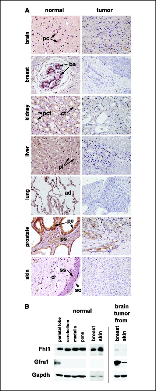 Figure 7. Fhl1 expression is suppressed in several types of human tumors. A, immunohistochemical staining was done on normal and tumor human tissue. Fhl1 staining was evident in cells in the brain, breast, kidney, liver, lung, prostate, and skin. In contrast, Fhl1 expression was suppressed in astrocytoma, breast carcinoma, renal carcinoma, hepatocarcinoma, pulmonary adenocarcinoma, prostatic carcinoma, and melanoma. pc, pyramidal cell of cerebral cortex; ba, buds of alveoli of mammary gland; pct, projena convoluted tubules of kidney; ct, collecting tubules of kidney; pl, plates of liver cells; ad, alveolar duct; pe, prostatic epithelium; ps, prostate stroma with smooth muscle; ss, stratum spinosum; sc, stratum corneum of skin; d, dermis. Bar, 100 μm. B, equal amounts of protein (10 μg/lane) from normal human brain (obtained from parietal lobe, cerebellum, medulla, and pons), breast, and skin were analyzed by Western blotting along with metastatic brain carcinoma derived from breast and melanoma derived from skin. Fhl1 was specifically suppressed in metastatic tumors relative to corresponding normal tissue. In contrast, Gfra1 was induced in the metastatic tumors and parietal lobe.