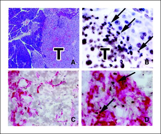 Figure 1. To show the contribution of bone marrow cells to tumor stroma. A, typical pancreatic β-cell tumor (T) that develops in the RIPTag mouse (×4). Donor-derived cells are identified following in situ hybridization for the Y chromosome. B, examination of the tumor border reveals numerous Y-positive cells (brown dots, arrows; ×60). The myofibroblast phenotype of male cells is illustrated by combining in situ hybridization for the Y chromosome with immunohistochemistry for α-SMA (C and D; ×20 and ×60); numerous donor-derived α-SMA-positive (red stain) cells are seen (arrows; D). Magnifications are objective magnifications.