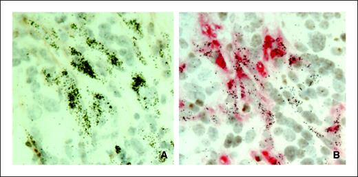Figure 2. To show in situ hybridization for pro(α1)I on pancreatic tumor tissue with and without in situ hybridization for the Y chromosome. A, bright-field image of the tumor which has undergone the processes required for in situ hybridization for pro(α1)I (×40). A dense collection of silver grains is seen over almost all spindle cells totally obscuring their cytoplasm. B, a similar area is seen, which has been treated to allow detection of α-SMA, the Y chromosome, and pro(α1)I (×40). In this image, the grain density is greatly reduced, illustrating how much of the ribomessage has been lost in carrying out this combined technique. Magnifications are objective magnifications.