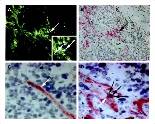 Figure 3. To show the functional activity of bone marrow–derived tumor stromal cells. A, dark-field image of a tumor section that has undergone a combination of in situ hybridization for DNA and RNA with immunohistochemistry for α-SMA to reveal functioning myofibroblasts (×20). The immunohistochemical stain shows spindle cells as green but white areas representing the autoradiographically visualized isotopically labeled riboprobe for pro(α1)I are present (white arrows); this area is magnified in the inset (×30). A bright-field image of the same area (B; ×20) shows the α-SMA-positive area (red stain). At higher power (C; ×50), α-SMA-positive cells (red stain) are clearly seen to be producing mRNA for pro(α1)I (black grains, white arrow). Functional donor-derived myofibroblasts are seen with all three markers in the same cell (D; ×50)—α-SMA red stain, along with expression of mRNA for pro(α1)I (black grains, black arrows) and detection of the Y chromosome (brown dot, white arrow). Magnifications are objective magnifications.