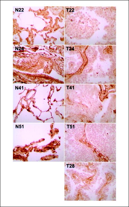 Figure 6. Immunohistochemical staining of Betaig-h3 protein in primary lung carcinomas (T22, T24, T28, T41, and T51) and matched noncancerous lung tissues (N22, N24, N41, and N51). Magnification, ×400.