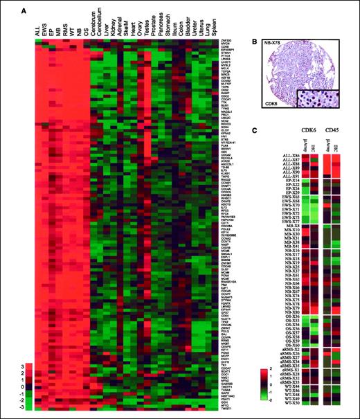Figure 3. A, identifying cancer-specific gene targets: heatmap of median tissue and tumor values for 120 differentially expressed genes between xenografts and normal tissues. A combination of t test (Bonferroni adjusted P < 0.01) and fold change (>5) filtering identified 248 clones, which mapped to 157 unique UniGene clusters, out of which 120 were known genes. Many of the genes belong to the functional annotation categories of cell cycle, cell division, DNA metabolism, and other gene ontology annotations that would suggest good therapeutic targets (Supplementary Table S4). B, tissue microarray image: positive CDK6 stain (nuclear) of a xenograft derived from a neuroblastoma cell line (SK-N-DZ). Original magnification, ×200. C, comparison of RNA expression and protein expression from gene expression microarrays and tissue microarrays, respectively. The data for the protein expression is the fraction of total cells that stained positive as measured by the Aperio ScanScope. Both the RNA and the protein expression data were z scored before heatmap visualization. Samples with missing cores on the tissue microarrays were excluded.