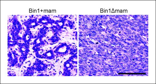 Figure 3. Increased histopathologic grade of DMBA-induced mammary tumors lacking Bin1. DMBA-induced mammary gland tumors excised at necropsy from Bin1+mam and Bin1Δmam mice were fixed in paraffin, and tissue sections were processed for H&E staining.