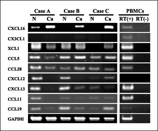 Figure 1. RT-PCR analysis of chemokine expression in CRC and normal mucosa. N, normal mucosa; Ca, CRC tissue. In all three cases, CXCL16 expression was stronger in cancer tissues than in normal mucosa. Other chemokines did not show such an expression pattern. GAPDH served as a loading control.