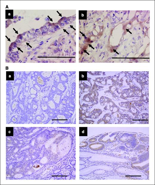 Figure 3. Immunohistochemical staining of CXCL16 in CRC. A, a, nonfixed frozen section. CXCL16 expression was apparently observed on the surface of cancer cells (arrow). b, formalin-fixed frozen section. CXCL16 was expressed in the cancer membrane as well as the cytoplasm (arrow). B, a, no CXCL16 expression case (absent). b, strong expression case. CXCL16 expression was observed in the cell membrane and cytoplasm of CRC cells. c, strong expression case. Note that, in the lower right part, normal colon epithelial cells were negative for CXCL16. d, the cytoplasm and cell membrane of the colon adenoma showed strong expression of CXCL16 but normal colon epithelial cells were negative (lower part). Magnification, ×200 (A), ×100 (B). Bar, 200 μm.