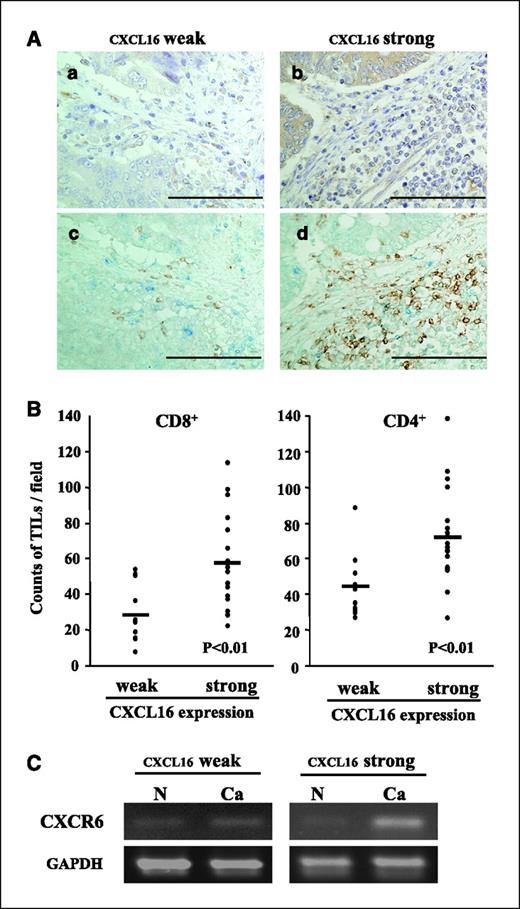 Figure 4. Immunohistochemical staining of T cells in CRC. A, a and c, weak CXCL16 expression case. b and d, strong expression case. TILs were observed at the tumor border. c and d, double immunohistochemical staining for CD8 (blue) and CD4 (brown). In this staining, the majority of TILs were identified as CD8+ or CD4+ cells. A larger number of TILs infiltrated CXCL16 strong cases. d, ×200 magnification. Bar, 200 μm. B, TIL counts. CD8+ and CD4+ TILs were counted in five randomly selected areas at the tumor border for each case. The average counts of TILs were plotted and compared between weak and strong CXCL16 expression groups. The number of CD8+ cells was significantly increased in the strong group (mean ± SD, 58.2 ± 25.2 per field) as compared to the weak group (29.3 ± 16.2 per field). Similarly, CD4+ cells were significantly increased in the strong group (71.9 ± 26.1 per field) as compared to the weak group (44.2 ± 17.8 per field). C, CXCR6 mRNA expression was analyzed by RT-PCR in a strong CXCL16 expression case and a weak expression case.
