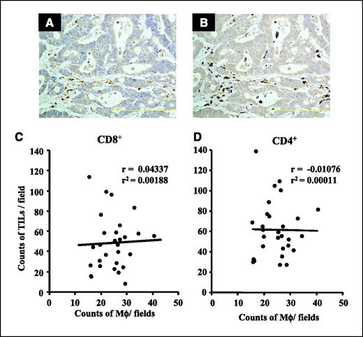 Figure 5. CXCL16-positive macrophages and TILs. A, immunohistochemical staining of CXCL16. CXCL16-positive mononuclear cells were observed in cancer tissue. B, immunohistochemical staining of CD68. CD68-positive macrophages were identical to CXCL16-positive mononuclear cells (A). C and D, no correlation between the number of CXCL16-positive macrophages and CD4+ and CD8+ TILs.
