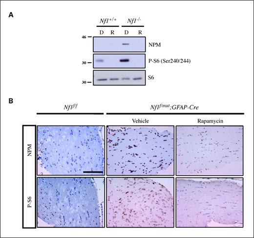 Figure 4. NPM expression is regulated by mTOR signaling in vitro and in vivo. A, NPM expression is increased in Nf1−/− astrocytes. Expression of NPM and phosphorylated S6 is inhibited by 10 nmol/L rapamycin. Immunoblotting for total S6 shows equal protein loading. B, phosphorylated S6 and NPM are expressed at low levels in wild-type murine optic nerve (Nf1f/f) but are dramatically increased in a murine model of optic glioma (Nf1f/mut;GFAP-Cre) as shown by immunohistochemistry. Following rapamycin treatment in vivo, both NPM and phosphorylated S6 expression are decreased in the mouse optic gliomas. Bar, 200 μm. Magnification, ×10.
