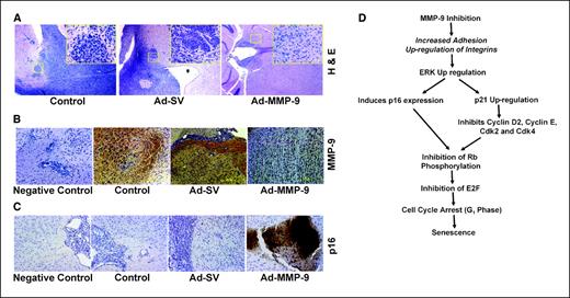 Figure 6. Tumorigenicity in vivo. Daoy cells were implanted intracranially in nude mice and treated with intratumoral injections of mock, Ad-SV, and Ad-MMP-9 as described in Materials and Methods. A, H&E staining of brain sections showing neoplastic growth (inset, ×20). Immunohistochemical analysis of MMP-9 expression (B) and p16 (C) expression in brain sections as described in Materials and Methods. D, proposed schematic model for Ad-MMP-9–mediated cell cycle dysregulation and induction of senescence.