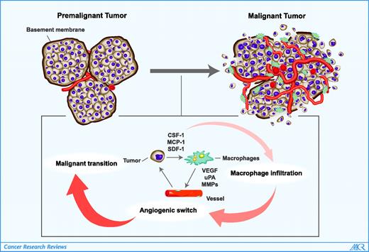 Figure 1. Macrophages promote tumor progression through stimulation of angiogenic switch. The development of a high-density vasculature is required for tumor progression to malignancy (top). The initiation of this process, termed the angiogenic switch, results from the interaction between the tumor and its microenvironment. Tumor-derived chemoattractants such as CSF-1 and monocyte chemoattractant protein 1 (MCP-1 or CCL2) induce the infiltration of macrophages. These macrophages then promote the development of a high-density vascular network through the secretion of multiple angiogenic growth factors and proteinases. The mature tumor vasculature provides support for tumor progression and metastasis.