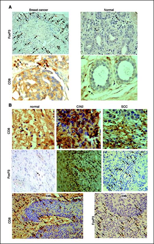 Figure 1. Presence of Tregs and CD8+ T cells in breast and cervical tissue samples. A, Tregs and CD8+ cells were detected on paraffin sections of normal breast and breast cancer (stage III and IV) tissue. FoxP3-positive cells appear with brown nuclei. CD8-positive cells show a brown surface staining. Representative pictures. Arrows, positive cells. B, Tregs and CD8+ cells were visualized on paraffin sections of normal cervix, precancerous cervix, and cervix cancer tissues. FoxP3-positive cells have brown nuclei. CD8-positive cells display a brown surface staining. Representative pictures. Arrows, positive cells.