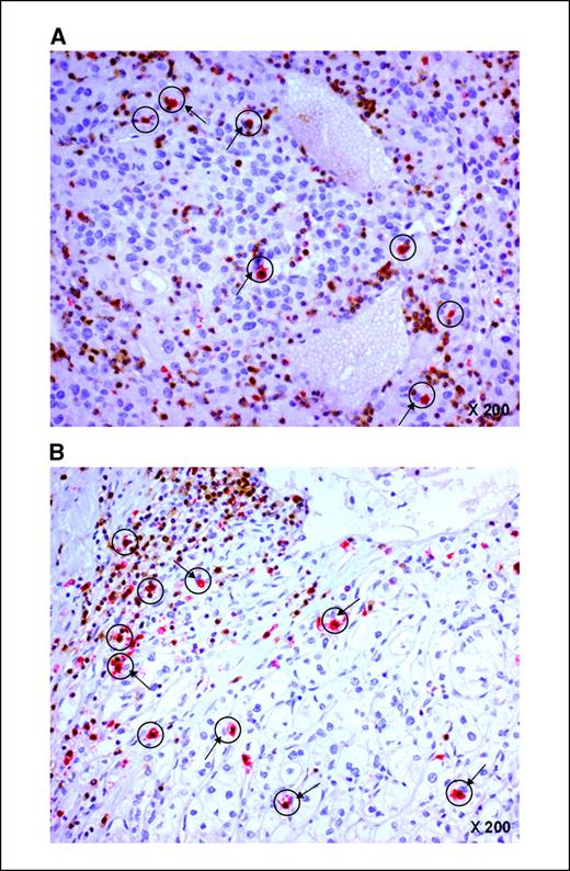 Figure 1. Immunohistochemical study of NK cells infiltrating primary tumors and lung metastases from RCC patients. Double staining with anti-CD3 (brown) and anti-CD57 (red) was carried out to detect NK and T cells in primary renal tumor (A) and lung metastases (B). CD57+/CD3− NK cells are in red circles. Arrows, tumor cells. Magnification, ×200.