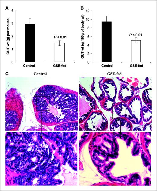 Figure 1. Inhibitory effect of oral GSE on prostate tumorigenesis in TRAMP mice. A and B, at the time of necropsy, after 24 wks of GSE feeding (200 mg/kg, 5 d/wk) starting from 4th week of age, each mouse was weighed, and the lower genitourinary tract (GUT), including the bladder, seminal vesicles, and prostate, was removed en bloc and weighed. P < 0.01 (Student's t test). Columns, mean (n = 20 mice per group); bars, SE. C, H&E staining of the dorsolateral prostate of control and GSE-fed mice sacrificed after 28 wks of age. Top left, magnification (×100) of a section through the dorsolateral prostate of the control mice showing increased epithelial stratification that almost fills the lumen of the ducts, enlarged diameter of the glands, distorted and bulging duct profiles, stromal thickening, and invasion. Bottom left, magnification (×400) of the bracketed section of the top left image. Top right, magnification (×100) of a section through the dorsolateral prostate of the GSE-fed mice showing duct profiles with infoldings and luminal space, intact basement membrane, and focal lesions of proliferating epithelial cells. Bottom right, magnification (×400) of the bracketed section of the top right image.