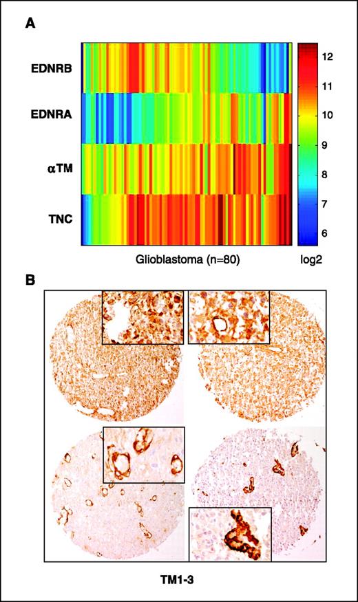 Figure 6. Expression of tenascin-C, EDNR, and tropomyosin in gliomas. A, gene expression of tenascin-C (TNC) and potential mediators as ordered by sorting points into neighborhoods (SPIN) analysis (32) for 80 glioblastoma. The ordering of points is iteratively permutated in search of a linear ordering. Expression is represented in a color scale (log2) as determined on GeneChip 133Plus2. B, four representative examples of immunohistochemical staining for TM1-3 of a glioma TMA.