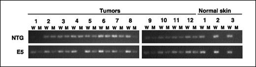 Figure 5. Detection of codon 61 mutations in H-ras. For each group of mice [line 32 E5 and nontransgenic (NTG) mice], 12 tumors (exophytic papillomas, endophytic papillomas, and carcinomas) and 3 samples of normal skin (controls) were analyzed for the presence of wild-type and mutant H-ras. Primers specific to the wild-type H-ras were used in each lane marked (W), whereas primers specific to the mutant H-ras were used each lane marked (M). Mutant H-ras is not detected in the normal skin controls compared with the tumors. There was no difference in H-ras mutation frequency in tumors collected from E5 mice compared with nontransgenic mice.