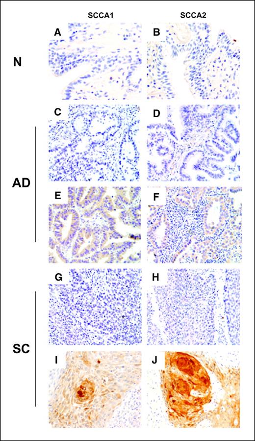 Figure 5. Microphotographs showing immunohistochemical expression of SCCA1 and SCCA2 in normal bronchial epithelium and non–small-cell lung cancer tumor tissue microarray tissue specimens. Normal bronchial epithelium (A and B), adenocarcinoma (C–F), and squamous cell carcinoma (G–J) tissue sections were subjected to immunohistochemical analysis with antihuman SCCA1 (left) and antihuman SCCA2 (right) antibodies. As negative control, we used the same specimens used as positive controls, replacing the primary antibody with PBS (C, D, G, and H). N, normal bronchial epithelium; AD, adenocarcinoma; SC, squamous cell carcinoma.