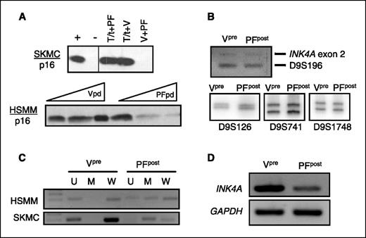 Figure 2. PAX3-FKHR–mediated bypass of cellular senescence is accompanied by p16INK4A protein loss, which is due to silencing of the INK4A gene via promoter methylation, but not INK4A allelic loss. A, top, p16INK4A immunoblot of SKMCs that have bypassed senescence by virtue of expressing SV40 DNA tumor virus early region T/t-Ag oncoproteins (T/t)PAX3-FKHR (PF) or vector (V). Bottom, p16INK4A immunoblot of HSMM cells expressing vector (V) or PAX3-FKHR (PF) as they accumulate population doublings (pd) over time. B, PCR-based assays of the INK4A exon 2 locus on chromosome 9p (top) or D9S chromosome 9p microsatellite markers (bottom) shows no homozygous or heterozygous INK4A allelic loss, respectively, in post-senescent (post) HSMM cells expressing PAX3-FKHR compared with pre-senescent(pre) vector control cells. A chromosome 9q microsatellite marker, D9S196, was included as a control target sequence to verify genomic DNA integrity. C, methylation-specific PCR of genomic DNA isolated from pre-senescent vector or post-senescent PAX3-FKHR HSMM cells reveals that the INK4A promoter has been methylated in those cells that have bypassed senescence. U, unmethylated bisulfite-modified DNA; M, methylated bisulfite-modified DNA; W, unmodified WT DNA. D, RT-PCR of RNA isolated from pre-senescent vector and post-senescent PAX3-FKHR cells verifies the expected transcriptional down-regulation of the INK4A gene. Glyceraldehyde-3-phosphate dehydrogenase (GAPDH) is included as a loading control.