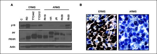 Figure 5. Down-regulation of p16INK4A in human rhabdomyosarcoma tumor tissue. A, p16INK4A and FOXO1A immunoblots of ERMS and ARMS human cell line lysates. The ARMS cell lines HR, JR, Rh28, and Rh30 express the PAX3-FKHR fusion protein (PF), whereas Rh18, although it is morphologically alveolar, does not. Actin immunoblot is included as a loading control. B, p16INK4A immunohistochemical staining of human ARMS and ERMS clinical tumor specimens. Brown color, immunoreactivity. Magnification, ×100.