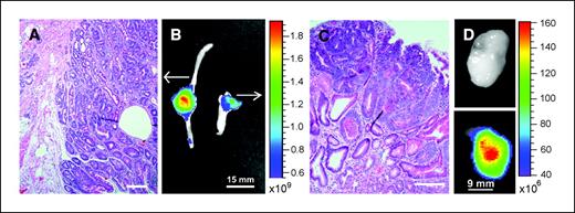 Figure 4. CTX:Cy5.5 imaging of adenocarcinomas and sarcomas. A–C, biophotonic image of adenocarcinoma (B, left) and adenoma (B, right) shows clear delineation from normal intestine. Histologic confirmation of (A) adenocarcinoma and (C) adenoma. D, ex vivo image of Rh30 xenograft from uninjected (top) and CTX:Cy5.5-injected (bottom) animals shows probe-specific signal.