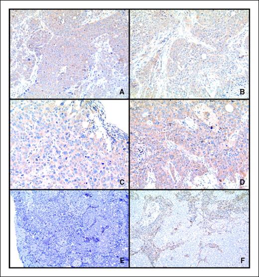 Figure 4. Immunohistochemistry of L2987 tumors with anti–VE-cadherin pretreatment (A) and posttreatment (B), anti–Tie-1 pretreatment (C) and posttreatment (D), and anti-AGTRL1 pretreatment (E) and posttreatment (F). Brown, presence of the protein; blue, hematoxylin counterstain. Images (A) to (D) were taken with a 20× objective and images (E) to (F) with a 10× objective.