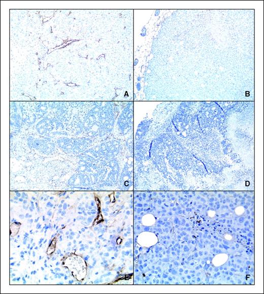 Figure 5. Immunohistochemical staining of HCT116 xenografts with collagen type IV antibody before treatment (A) or after treatment (B). Anti-C1QR1 staining in GEO xenografts before (C) and after (D) treatment. Higher magnification of collagen type IV staining in HCT116 before (E) and after (F) treatment. Brown, presence of the protein; blue, hematoxylin counterstain. Note the absence of positively stained cells in (F). Images (A) to (D) were taken with a 10× objective and images (E) to (F) with a 40× objective.