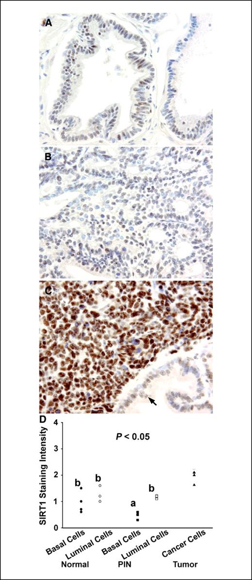 Figure 3. SIRT1 immunostaining taken at ×400 magnification in the DLP from TRAMP mice with pathologic score of 1 (n = 4), 3 (n = 4), or 6 (n = 4), indicating normal tissue, high-grade PIN, or poorly differentiated prostatic adenocarcinoma, respectively. SIRT1 staining in a normal prostate (A), SIRT1 staining in a high-grade PIN lesion (B), and SIRT1 staining in poorly differentiated adenocarcinomas (C); note the contrast in staining between the cancer cells and the adjacent uninvolved gland (arrow). SIRT1 staining intensity in normal cells, PIN lesions, and tumors (D). Different symbols represent SIRT1 staining intensity for cell types present in each specimen. Different letters (a–c) denote a significant difference between groups, such that groups not sharing a similar letter are significantly different from each other (P < 0.05).