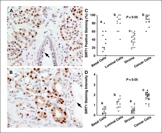 Figure 5. SIRT1 immunostaining in human prostate cancer cases. A and B, SIRT1 staining at ×400 magnification from two different prostate cancer cases. Note the greater staining intensity in the surrounding cancer cells than adjacent stromal cells and the uninvolved gland (arrows). Also notice that greater staining is observed in the luminal cells than basal cells in the uninvolved gland. C, percentage of cells positively stained for SIRT1 in the cancer cases. D, SIRT1 staining intensity in human prostates for basal cells and luminal cells from uninvolved glands, stromal cells, and cancer cells. Symbols represent SIRT1 staining intensity for cell types present from each individual case. Different letters (a–c) denote a significant difference between groups, such that groups not sharing a similar letter are significantly different from each other (P < 0.05).