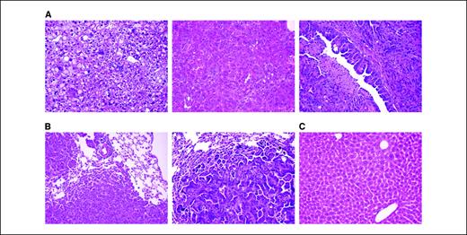 Figure 1. A, histologic features of liver tumors induced by RCAS-PyMT in Trp53 null livers. Tumors with features of large cell dysplasia (left), hepatocellular carcinoma (center), and cholangiocarcinoma (right) are present. B, metastatic lung lesions derived from a hepatocellular carcinoma (left) and a cholangiocarcinoma (right). C, histology of a liver from an age-matched animal injected with RCAS-GFP.
