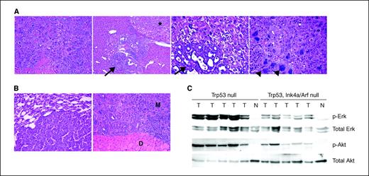 Figure 3. A, histologic findings in RCAS-PyMT–injected Trp53 plus Ink4a/Arf null livers. Left, hepatocellular carcinoma. Middle left, cholangiocarcinoma (arrow) growing adjacent to a hepatocellular carcinoma (*). Middle right, aggressive cholangiocarcinoma (arrow) within a hepatocellular carcinoma. Right, hepatocellular carcinoma cells with giant nuclei (arrowheads). B, metastatic lesions from Trp53 plus Ink4a/Arf null tumors found in the lung (left) and diaphragm (right). M, metastatic lesion; D, diaphragm. C, immunoblots demonstrating levels of phosphorylated and total Erk 1/2 and Akt in Trp53 null and Trp53 plus Ink4a/Arf null liver tumors. T, tumor; N, normal liver.