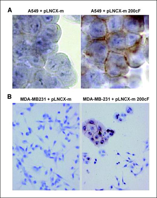 Figure 4. Cell morphology and E-cadherin staining in cells expressing miR-200c in comparison with controls. A, cytospins of A549 cell lines at 7 d show little or no staining for E-cadherin at the boundaries of cells that do not overexpress miR-200c, but strong staining is seen in overexpressing cells (+ 200cF). B, MDA-MB-231 cells grown on coverslips for 7 d and fixed to preserve morphology. Cells that do not express miR-200c have normal morphology and do not stain for E-cadherin. Cells expressing miR-200c show mixed cell population, with those positive for E-cadherin having a different morphology (+ 200cF).