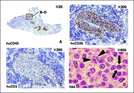 Figure 2. Histomorphologic appearance of recovered human cells in the murine spleen. A, focal aggregates of human CD45+ cells clustering around splenic arterioles (×25 magnification). B, subpopulation analysis of focal aggregates reveals predominantly human CD20+ CLL cells (×200 magnification) interspersed with a smaller population of human CD3+ T cells (×200 magnification; C). D, focal aggregates of human cells compose predominantly two lymphoid populations, fitting the histologic criteria of prolymphocytes (→ ←) and paraimmunoblasts (▸ ◂).
