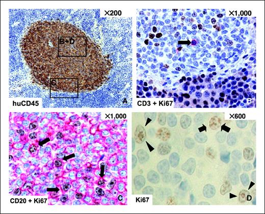 Figure 3. Immunohistologic characterization of CLL cells localized in focal aggregates in the spleens of NOD/SCID mice. Serial immunohistologically stained sections of a murine spleen showing focal engraftment of CD45+ human lymphoid cells were investigated. A, a representative focal aggregate composed of human CD45+ cells. B and C, double immunostaining of Ki67 (brown) and CD3 (red; B) or CD20 (red; C) identifies a single CD3+ but Ki67− cell (B, →) but multiple CD20+ cells coexpressing Ki67 (C, →) within the splenic focal aggregate. About 10% of the aggregate composing cells show Ki67 positivity (C and D). Ki67 staining seems to be restricted to cells with activated either prolymphocytic (→ ←) and/or paraimmunoblast (▸ ◂) phenotype (D).