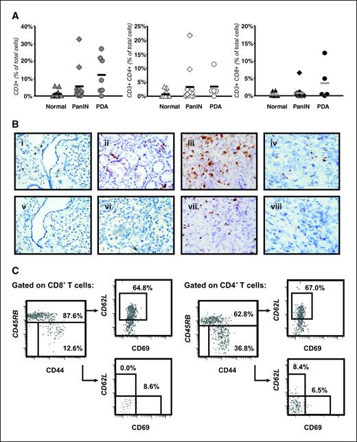 Figure 3. Characterization of T cells in pancreas of normal, PanIN, and PDA mice. A, percentage of T-cell subsets in the pancreas from normal (triangles; n = 13), PanIN (diamonds; n = 12), and PDA (circles; n = 7) mice as determined by flow cytometry. Left, total CD3+ T cells; middle, CD3+ CD4+ T cells; right, CD3+ CD8+ T cells. Comparison of means by three-way ANOVA: P = 0.02 for CD3+ T cells, P = 0.29 for CD4+ T cells, and P = 0.04 for CD8+ T cells. Symbols, data from each animal; bars, mean percentage for the group. B, immunohistochemical detection of CD4 in normal pancreas (i), PanIN pancreas (ii), two different PDA pancreata (iii and iv), and of CD8 in normal pancreas (v), PanIN pancreas (vi), and two different PDA pancreata (vii and viii). iii–iv and vii–viii, variability in T-cell infiltration between animals. Original magnification, 400× (i–ii and v–vi) and 200× (iii–iv and vii–viii). C, after gating on CD45+ CD3+ CD8+ lymphocytes (left) or CD45+ CD3+ CD4+ lymphocytes (right), subsequent daughter gates were drawn to separate CD45RBhigh CD44low naive-like T cells from CD45RBlow CD44high antigen-experienced T cells and then to examine CD62L and CD69 expression on each of these populations. Numbers, percentages of the parent gate. Representative flow cytometric results are shown for one of four PDA mice. Details of the statistical analysis including mean and SE are noted in Supplementary Table S1.