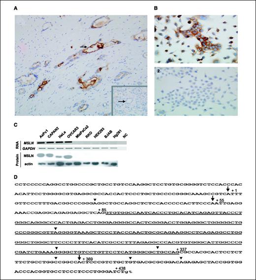 Figure 1. MSLN RNA and protein overexpression in tissues and representative cell lines. A and B, MSLN is labeled immunochemically. A, MSLN protein overexpression characterizes most pancreatic adenocarcinomas. Arrows, a cancerous duct and a normal duct (inset) from the same patient. B.1, MSLN protein overexpression localizes to cellular membranes. The AsPc1 cell line is depicted as a representative example. B.2, the MiaPaCa2 cell line is immunocytochemically negative for MSLN. C, MSLN overexpression is restricted to certain cell lines. AsPc1 and CAPAN2 represent pancreatic, and HeLa represents nonpancreatic cancer-specific MSLN overexpression. OVCAR3 represents overexpression in a cancer arising in a tissue normally expressing MSLN (ovary). HEK293 (human embryonic kidney), BJAB (Burkitt's lymphoma), and HG261 (human noncancerous fibroblasts) represent cancerous and noncancerous cells not expressing MSLN. The glycosylated (slower) and deglycosylated (faster) forms of MSLN protein can be distinguished. Glyceraldehyde-3-phosphate dehydrogenase (GAPDH) and actin are loading controls. RNA, RT-PCR detection of the MSLN and GAPDH gene. Protein, immunoblots using specific antibodies against MSLN and actin. NC, no template PCR. D, identification of promoter and transcriptional start sites. Sequence of the 5′-end of the MSLN gene, including the MSLN promoter identified here. Sequencing of 5′-RACE products revealed 10 different possible transcriptional start sites, 3 corresponding to the consensus initiator sequence (overlying arrows), the rest to nonconsensus start sites (arrowheads). Underlined, a cryptic intron excised at cryptic splice sites that define the borders of alternate exons 1A and 1B. The translation start site lies in exon 2, not depicted. Lower case letters, start of intron 1.