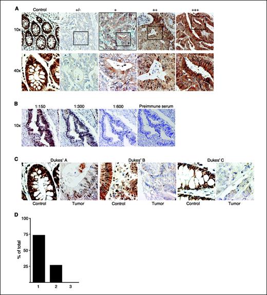 Figure 3. Representative CysLT2R immunohistochemical staining of normal human colon tissue and colorectal adenocarcinomas. A, top, staining of normal control tissue and the degree of CysLT2R staining of the carcinomas (+/− to +++; 10× objective). Bottom, an enlargement of the area inside the boxes (40×). B, a series of sections from the same paraffin block (note that sections are not in order), showing three dilutions of CysLT2R antibody and rabbit preimmune serum. C, representative pairs of control and tumor immunostaining from Dukes' A, B, and C patients stained with CysLT2R antibody (diluted 1:300). D, distribution of CysLT2R in normal versus tumor tissue in different stages of colon cancer. Group 1 represents patients with higher staining for CysLT2R in normal compared with tumor colon tissue. Group 2 represents patients with equal staining for CysLT2R in normal and tumor colon tissue. Group 3 represents patients with lower CysLT2R staining in normal compared with tumor colon tissue.