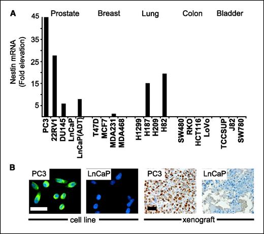 Figure 1. Nestin expression in carcinoma cell lines. A, real-time RT-PCR of Nestin transcripts in carcinoma cell lines from five different tissues. Values represent fold elevation above benign human PrEC. LnCaP(ADT) labels LnCaP cells that were subjected to androgen withdrawal in culture for 72 h. B, photomicrographs showing differential expression of Nestin protein in PC3 and LnCaP cultures and tumor xenografts. Bar, 50 μm.