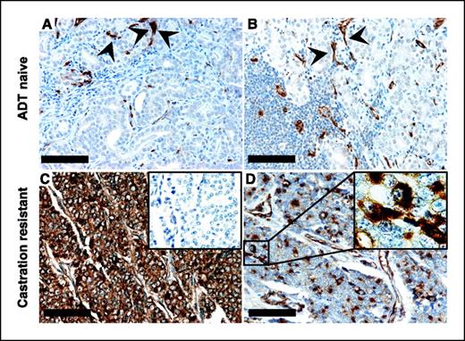 Figure 2. Nestin expression identifies lethal prostate tumors. Photomicrographs showing a ADT-naive localized tumor with no metastasis at time of surgery (A), a ADT-naive regional (pelvic) lymph node metastasis (B), as well as two metastatic lesions from castration-resistant lethal prostate cancer cases displaying a high percentage (95%; C) versus a low percentage (20%; D) of Nestin-positive tumor cells. C, inset, no positivity was detectable in the corresponding IgG control stainings that were done to rule out unspecific labeling of tumor cells. D, inset, high magnification showing cytoplasmic Nestin staining in cancer cells. Nestin-positive small blood vessels were seen in all samples (arrowheads) and served as a positive internal control for staining quality but were still clearly distinguishable from positive tumor cells at high-power magnification. Nestin staining in tumor cells was detected only in lethal cases. Bar, 100 μm.