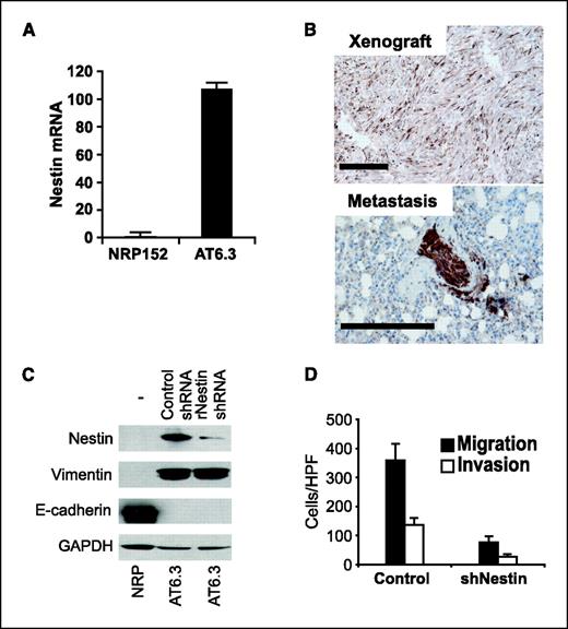 Figure 4. Nestin knockdown in rodent AT6.3 prostate carcinoma cells impairs cell motility. A, real-time RT-PCR showing that Nestin mRNA levels are >100-fold higher in AT6.3 cells compared with benign rat PrECs (NRP152). Columns, mean; bars, SD. Assays were done in triplicate. B, immunohistochemistry shows heterogeneous expression of rat Nestin in an AT6.3 xenograft at the site of inoculation. In contrast, ∼100% of the AT6.3 cells in an intrapulmonary micrometastatic lesion stain positive. Bar, 100 μm. C, Western blot showing near-complete knockdown in AT6.3 cells stably transfected with a shRNAmir construct targeting rat Nestin (rNestin shRNA1) when compared with the same cells stably transfected with a scrambled control shRNA construct (Control shRNA). Untransfected (−) benign rat PrECs (NRP) lack detectable Nestin protein. Expression of the epithelial to mesenchymal transition–associated markers vimentin and E-cadherin is not affected. D, modified Boyden chamber assays show marked decrease in migratory and invasive ability in AT6.3-siNestin cells (P < 0.0001). Assays were done in triplicate.