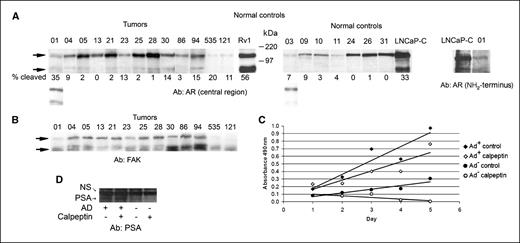 Figure 3. Human prostate tumors express the tr-AR. A, tumors 01, 30, and 94 express higher levels of an AR isoform that is similar in size to the isoform detected in CWR22Rv1. Bottom, a longer exposure that shows that although the tumor sample and control prostate tissue express similar amounts of the AR, the tumor samples have much higher levels of the truncated isoform. A Western blot analysis using an antibody directed against the NH2-terminal region of the AR and tumor sample 01 confirms that the truncated form has a COOH-terminal deletion. Partially cleaved LNCaP AR (lighter exposure) served as a marker. Tumor samples were flash frozen in liquid nitrogen within 30 min of tumor resection and stored in liquid nitrogen to minimize proteolytic activity. B, expression of cleaved FAK (90-kDa form) is higher in tumor samples that have elevated levels of the tr-AR. C, growth curve of Rv1 cells proliferating in AD+ media (closed rectangles), AD+ media and 40 μmol/L calpeptin (open rectangles), AD− media (closed circles), and AD− media and 40 μmol/L calpeptin (open circles). Cellular proliferation was quantitated using the MTS assay. D, Western blot analysis of PSA expression in Rv1 cells proliferating in AD+ and AD− media, in the presence or absence of calpeptin. NS, nonspecific band.