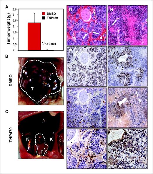 Figure 4. Treatment of established murine neuroblastoma tumors with TNP-470. Animals with intermediate tumors were treated with either DMSO or TNP-470 (100 mg/kg i.p. thrice weekly) for 2 wks (eight per group). A, tumor weight was significantly reduced in the TNP-470–treated group compared with DMSO-treated controls (P < 0.001). B, DMSO-treated tumors progressed to group III. Dashed white line defines extent of tumor; K, kidney. C, TNP-470–treated tumors were grossly smaller (arrows). D–K, histologic and immunohistochemical appearance of DMSO (D–G) and TNP-470–treated (H–K) tumors. DMSO-treated tumor shows lobular neuroblasts with surrounding intact microvasculature (D, arrows). In response to treatment with TNP-470, this architecture was effaced by areas of hemorrhagic necrosis and apoptosis (H). Arrow in H, residual large caliber blood vessel. Proliferation, assessed by staining of Ki67 (E), was significantly reduced in response to TNP-470 treatment (I) and was limited to perivascular areas (arrows in I). Apoptosis, assessed by staining of cleaved caspase-3 (F), was increased in response to TNP-470 therapy (J). Staining pattern of the vascular marker CD31 was altered by therapy (K). Arrows in G show linear staining pattern associated with tumor microvessels that are lost in K, although staining of residual large vessels is maintained. A, columns, mean; bars, SE (n = 8 mice per group).