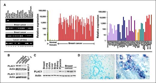 Figure 1. PLAC1 is a trophoblastic lineage marker aberrantly activated in cancer cells. A, left, end point 35-cycle RT-PCR in normal tissues, primary breast cancer samples, and cancer cell lines (1, MCF-7; 2, MDA-MB-435S; 3, BT-549; 4, MDA-MB-231; 5, SNU-16; 6, LCLC-103H; 7, KYSE-510; 8, KYSE-30; 9, EFO-27; 10, TOV-21G; 11, TOV-112D; 12, CAOV-3; 13, EFO-21; 14, FU-OV-1; 15, LNCAP; 16, CAPAN-2). Middle, quantitative 40-cycle real-time RT-PCR in normal tissues (1, Testis; 2, Placenta; 3, Brain; 4, Lung; 5, Breast; 6, Colon; 7, Liver; 8, Stomach; 9, Kidney; 10, Prostate; 11, Pancreas; 12, Ovary; 13, Spleen; 14, Skin; 15, Myocard; 16, Endometrium; 17, rest. PBMCs; 18, prolif. PBMCs; 19, Adrenal gland), primary breast cancer specimens, and cancer cell lines (right). Light purple, colon cancer; blue, lung cancer; dark purple, ovarian cancer; yellow, melanoma; green, prostate cancer; red, breast cancer; brown, cervical cancer. B, Western blot analysis of siRNA-mediated decrease of PLAC1 protein expression. Control cells were either not treated or transfected with a scrambled nonsilencing duplex (ns-siRNA). C, Western blot analysis of PLAC1 protein levels in normal and neoplastic human tissues. D, immunohistochemistry of sections derived from normal human breast tissue (left) and breast cancer (right) using a PLAC1-specific antibody.