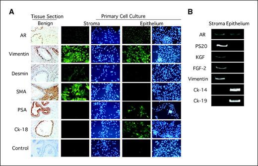 Figure 1. Immunocytochemical analysis of prostatic epithelial and stromal cell markers. Expression of AR and cellular markers in prostate stromal and epithelial cells. A, formalin-fixed, paraffin-embedded tissue sections and primary cell cultures. Tissue sections and primary cell cultures of stromal and epithelial cells were stained for AR, vimentin, desmin, smooth muscle actin (SMA), PSA, and cytokeratin 18 (Ck-18). Negative controls included immunocytochemical assays without primary antibody or with nonspecific IgGs. Stromal cells express markers consistent with stroma. Epithelial cells express markers consistent with epithelia. B, gene expression of AR and cellular markers by PCR total RNA from primary cultured stromal and epithelial cells were isolated. The expression of stromal and epithelial cell markers were determined using standard reverse transcription-PCR and primers specific for AR, ps20, KGF, FGF-2, vimentin, cytokeratin-14, and cytokeratin-19. Cells cryopreserved in liquid nitrogen for 1 yr were recovered with ∼90% viability.