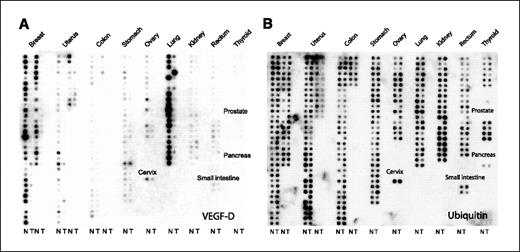 Figure 1. Expression of VEGF-D RNA by human tumors. A, to estimate the expression levels of VEGF-D in human tumor samples, we performed a dot blot analysis of VEGF-D mRNA in 241 human tumors (T) and corresponding normal tissues (N) from individual patients on a cDNA tissue array. Whereas VEGF-D was expressed in many normal tissues, its expression was in general down-regulated in tumors. No difference in the expression of the housekeeping gene ubiquitin was detected between the normal and tumor tissues in the same array (B).