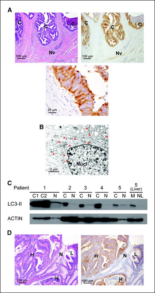 Figure 5. LC3-II was expressed in colorectal cancer tissues. A, LC3 protein was detected with immunohistochemistry using paraffin-embedded colon cancer samples. Top left, HE staining. Original magnification, ×100. Top right, LC3 immunostaining. Original magnification, ×100. LC3 was detected in cancer tissue (C) and intermuscular nerve cells (Nv). Bottom, magnified LC3-positive cancer tissue. Original magnification, ×400. B, ultrastructure of a surgically resected colon cancer shown by electron microscopy. Lipid bilayer structures engulfing organelles (*) are shown in the cytoplasm. Nucl, nucleus. Original magnification, ×2,000. C, total cell lysates were prepared from surgically resected primary and metastatic liver adenocarcinoma specimens and LC3-II was detected with Western blotting. N, noncancerous tissue; M, metastatic liver adenocarcinoma tissue; NL, noncancerous liver tissue. Case 1 had two independent primary tumors. D, LC3 was not detected in nonneoplastic tubules (N), whereas low-grade adenomatous component (L) showed weak LC3 positivity and high-grade adenomatous component (H) showed strong LC3 positivity. Original magnification, ×100.