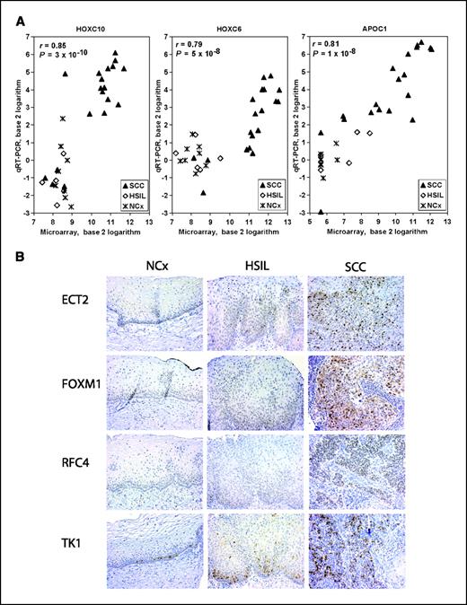 Figure 2. Validation of microarray data by qRT-PCR and immunohistochemistry. A, comparison of HOXC10, HOXC6, and APOC1 gene expression from microarray and qRT-PCR analyses. RNA for qRT-PCR were extracted from SCC (n = 19), HSIL (n = 5), and normal cervix (n = 8) samples isolated by LCM. For each gene, the mean relative expression (normalized to HPRT1) based on qRT-PCR analysis is plotted against the expression measure obtained from the microarray analysis. The Pearson's correlation (r) and its significance (P) are given. B, immunohistochemical analysis of Ect2, FoxM1, Rfc4, and TK1 protein expression in representative normal cervix (NCx), HSIL, and SCC tissue samples. Tissue sections were immunostained with antibodies recognizing the indicated proteins. Original magnification, ×200.