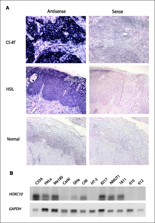 Figure 3. HOXC10 expression in cervical tissue samples and cell lines. A, in situ hybridization was used to detect HOXC10 transcripts in primary tissue samples. Sections from invasive SCCs, HSILs, and normal cervical tissues were hybridized with digoxigenin-labeled HOXC10 antisense (left panels) and sense (right panels) riboprobes. Original magnification, ×400. B, Northern blot analysis of HOXC10 mRNA in the indicated cell lines; expression of GAPDH was used as a loading control.