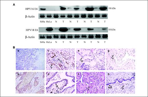 Figure 1. A, Western blot analysis for E6 protein expression of HPV16 and HPV18. Results of HPV16 or HPV18 E6 protein in lung tumor (T) and adjacent normal tissues (N). SiHa and HeLa cervical cancer cell lines were used as positive control for HPV16 and HPV18, respectively. B, immunohistochemical analysis of HPV16 or HPV18 E6 protein in lung tumors and adjacent normal tissues. a, a negative result of immunostaining in tumor cells (×100); b, HPV16/18 E6 protein expressed in cervical tumors as positive control (×200); c, HPV16 E6 protein expressed in tumor cells (T) and lymphocytes (L; ×400); d, HPV16 E6 protein expressed in bronchiole epithelial cells (e; ×400); e, HPV16 E6 protein expressed in alveolar macrophage (M; ×400); f, HPV18 E6 protein expressed in adenocarcinoma cells (T; ×400); g, HPV18 E6 protein expressed in endothelial cells of blood vessel (e; ×400); and h, HPV18 E6 protein in bronchiole metaplasia (BM) and type II pneumocytes (P; ×400).